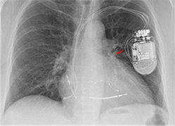 Lage des implantierten Lungenarteriendruck-Sensors im Röntgenbild (roter Pfeil)