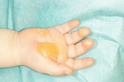 Kinderhand mit Verbrühungsblasen