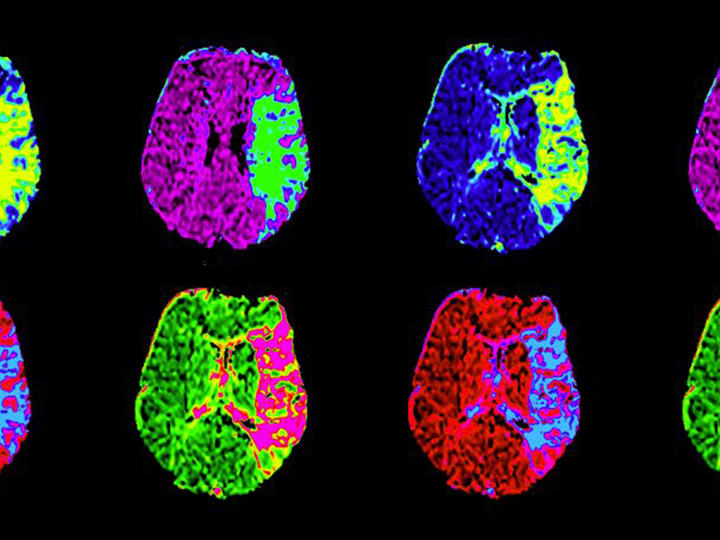 eingefärbte schematische Darstellung von Gehirnarealen mit Schlaganfall